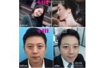 明星都在做的线雕，你也来试试吧